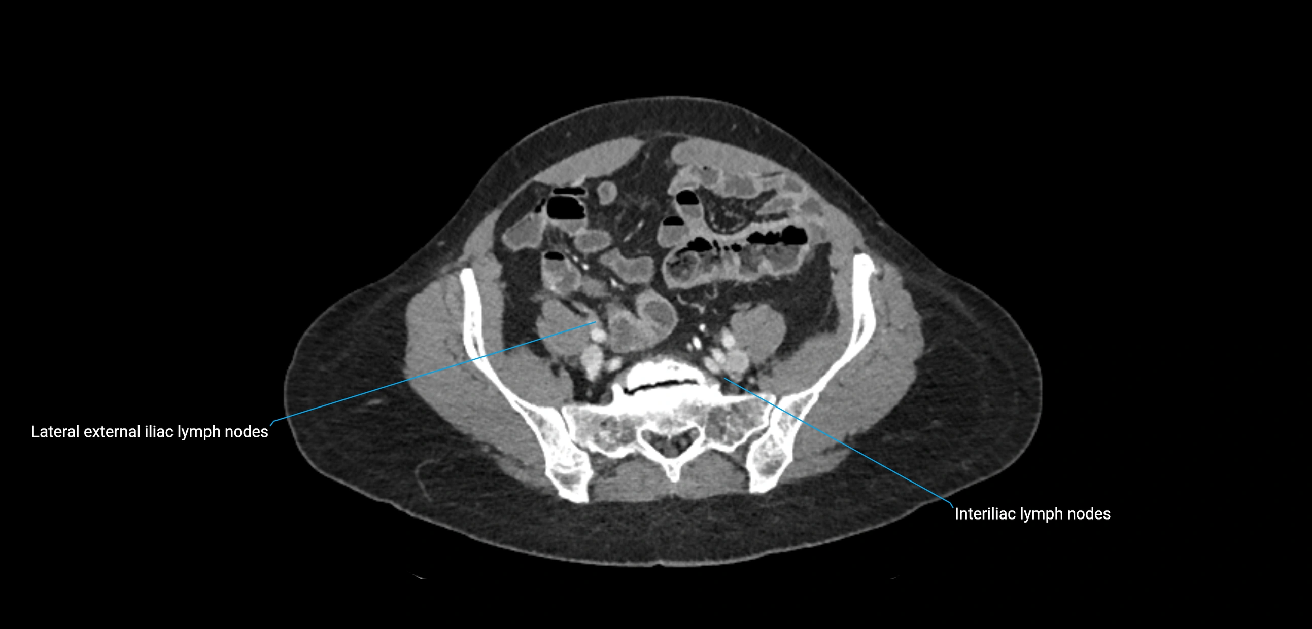 CT ct abdominal lymph nodes  axial cross sectional anatomy  enchanced radiology image -img-00002-00319.webp